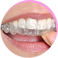 <p>Invisalign-Schiene</p><br />